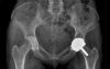 Resurfacing arthroplasty of the left hip. Cyst on the superior surface of the cup most likely due to osteolysis