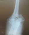 Old neglected fracture lower end humerus AP View