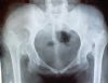 Bilateral dislocation hip