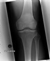Patello-femoral Osteoarthritis - AP View (1)