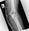 Anterior elbow dislocation with an associated radial head fracture - Post reduction - AP view (3)