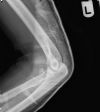 Anterior elbow dislocation with an associated radial head fracture - Post reduction - Lateral view (4)