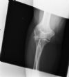 Radial head fracture with a fat  pad sign - AP view (1)