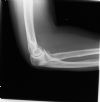 Radial head fracture with a fat  pad sign - Lateral view (2)