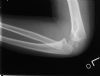 Displaced  fracture  of  the  lateral  epicondyle  of  the  humerus - Lateral view (2)