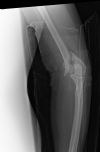 Comminuted intercondylar  fracture through the distal humerus - AP view