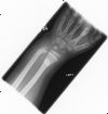 Displaced , dorsally angulated  fractures of the distal left  radius and ulnar - AP view (1)