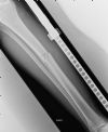 Non displaced mid shaft fracture  of the right tibia - AP view