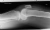 Lateral tibia pleateau fracture - Lateral view (2)