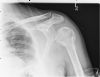 Same fracture following another fall - now the fracture is impacted again with subluxation of the shoulder - AP view (4)