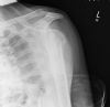 Same fracture following another fall - now the fracture is impacted again with subluxation of the shoulder - Axillary view (6)