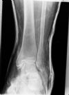 Bimalleolar Left Ankle Fracture - in Back slab - AP view (3)