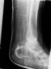 Bimalleolar Left Ankle Fracture - in Back slab - Lateral view (4)