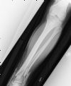 Open displaced fractures of the distal fibula and tibia - AP view (1)