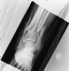 Open displaced fractures of the distal fibula and tibia - AP view (2)