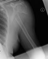Off ended Proximal Humeral Fracture - AP view (1)