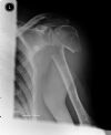 Off ended Proximal Humeral Fracture - Axial view (2)