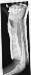 Dorsally angulated fracture of  the right distal radius - in POP - AP view (3)