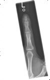 Left index finger ternimal phalanx / tuft fracture - AP view (1)