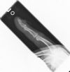 Left index finger ternimal phalanx / tuft fracture - Lateral view (2)