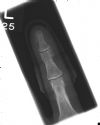 Left index finger ternimal phalanx / tuft fracture - in mallet splint - AP view (3)