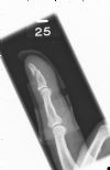 Left index finger ternimal phalanx / tuft fracture - in mallet splint - Lateral view (4)
