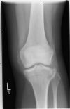 Lateral Tibial plateau fracture - AP view