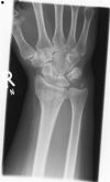 Fracture of the Distal radius with avulsion of the styloid process  of the ulna - AP view (1)