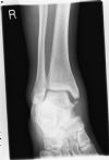 Maisseoneurve fracture - AP view of the ankle (1)