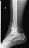 Maisseoneurve fracture - Lateral view of the ankle (2)