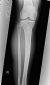 Maisseoneurve fracture - AP view of the tibia and fibula (3)