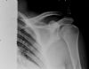 complex left shoulder injury with dislocation of the acromioclavicular joint. The coracoclavicular distance is increased. There is an intra-articular fracture of the left glenoid.