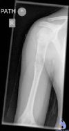 Fracture through simple bone cyst in child, with dropping fragment sign