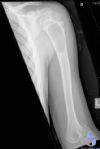 Simple bone cyst in 7 year old of proximal humerus.