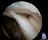 SLAP Type 4 tear at shoulder arthroscopy
