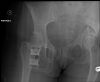 Displaced fracture through the  Left iliac wing as well as fractures through the Right  superior and inferior rami   