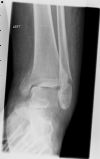 Left Ankle Trimalleolar Fracture - AP view (1)