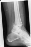 Left Ankle Trimalleolar Fracture - lateral view (2)