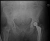 Non-displaced periprosthetic  fracture of the Left proximal  femur just underneath the Greater Trochanter - AP View