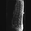 L3 Lumbar vertebral fracture. Sagittal MRI T1 (1). Courtesy of www.healthengine.com.au