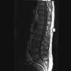 L3 Lumbar vertebral fracture. Sagittal MRI T1 (2). Courtesy of www.healthengine.com.au