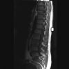 L3 Lumbar vertebral fracture. Sagittal MRI T1 (3). Courtesy of www.healthengine.com.au