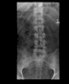 L3 Lumbar vertebral fracture. AP radiograph. Courtesy of www.healthengine.com.au