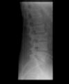 L3 Lumbar vertebral fracture. Lateral radiograph. Courtesy of www.healthengine.com.au