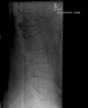 L1 Lumbar vertebral fracture. Lateral radiograph. Courtesy of www.healthengine.com.au