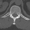 L1 Lumbar vertebral fracture. Axial CT (1). Courtesy of www.healthengine.com.au