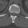 L1 Lumbar vertebral fracture. Axial CT (2). Courtesy of www.healthengine.com.au