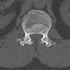 L1 Lumbar vertebral fracture. Axial CT (4). Courtesy of www.healthengine.com.au