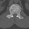 L1 Lumbar vertebral fracture. Axial CT (5). Courtesy of www.healthengine.com.au