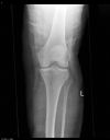 Left knee postero-medial dislocation. Ouch! AP radiograph post manipulation. Courtesy of Dushan Atkinson